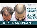 Perfecti hair transplant 1 month update at medlinks india  grade 3a baldness  4730 grafts