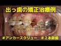【矯正】アンカースクリューを用いた出っ歯の上顎2本抜歯ワイヤー矯正治療例│上顎前突│ projecting teeth/buckteeth