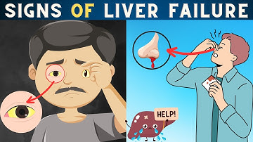 Liver Failure  Symptoms : 8 Signs your Liver Crying for Help