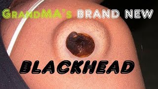 Grandma's Brand New Blackhead. Extravagant Blackhead Extraction.