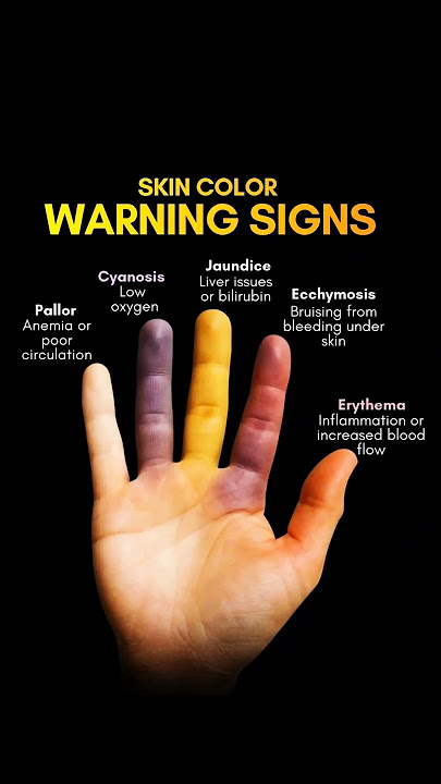 Skin Color Changes: Early Warning Signs You Shouldn't Ignore - YouTube