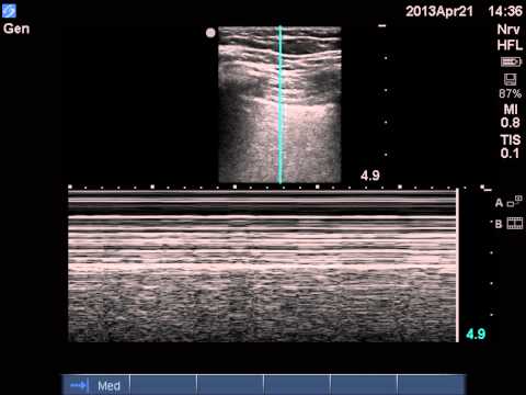 Videó: Légi Utazás és A Pneumothorax Előfordulása Lymphangioleiomyomatosisban