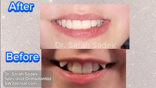 Before and After Braces. Severe Crowding. Treatment Lenght 11months