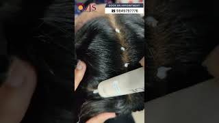 How to get rid of Stubborn Dandruff with Scalp Exfoliation? VJ’s vocational Courses