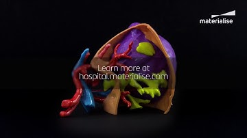 How to Create a 3D Printed Renal Carcinoma Model | Mimics InPrint | Materialise Medical