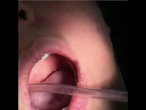 удалили мипому  из щеки операция во рту