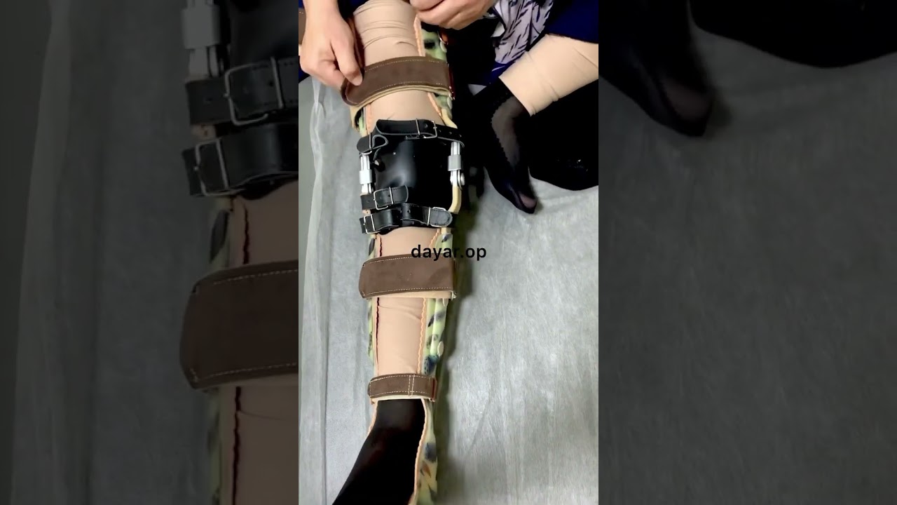 kAFO orthosis for post polio patient