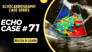 Echo Case 71 - Echocardiography Cases - Educational Video
