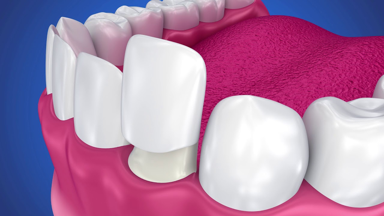 Are All Veneers The Same? | Hamilton Family Dentistry