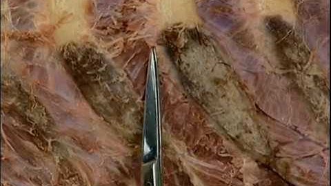 Section 3: Thorax Step 3. External and Internal Intercostal Muscles