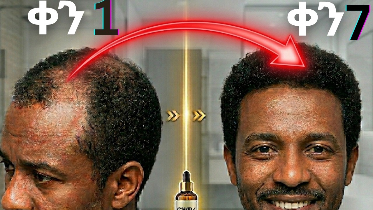 የራሰ በረሃነት ማቆሚያ መፍትሄ! ፀጉርን መልሶ ለማሳደግ 5 ሳይንሳዊ መንገዶች