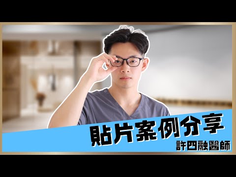 【漾無瑕陶瓷貼片 #3】許四融醫師貼片案例分享！想當帥哥美女，牙齒一定要先顧好｜【祐民牙醫－隱適美旗艦店】鑽石級楊大為醫師