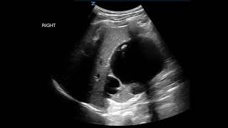 Renal Ultrasound | Sonoguide