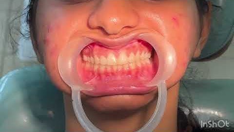 Demonstration of Pulp Vitality