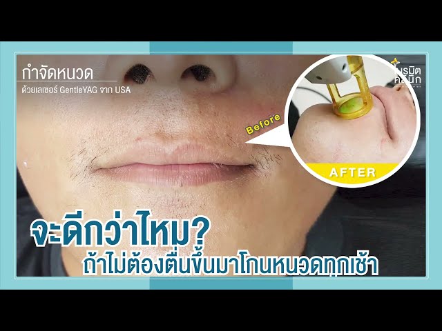 กำจัดขน Gentle YAG LASER EP.31/ไม่ต้องตื่นมาโกนหนวดทุกวันแล้ว @หมอปุ๊ Neramit Clinic