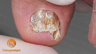 Immediate relief. General cleaning of abrupt edge nails in an 85-year-old patient with mixed mycosis