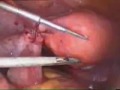 Recanalization of fallopian tube drnutan jain