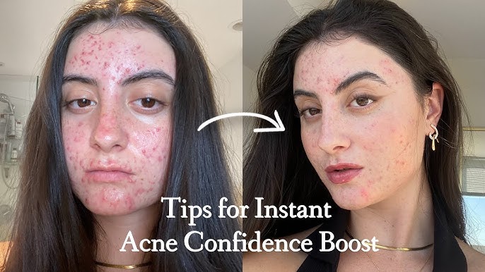 Hormonal Acne Isn't Real?! Going to the Doctor About my Acne After Coming  off of Birth Control 