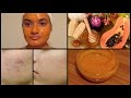 How to get rid of DARK SPOTS, PIGMENTATIONS & ACNE SCARS | Papaya Face Mask