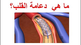 قسطرة القلب و دعامات الشرايين التاجية   دعامة القلب و توسيع الشرايين التاجية بالقسطرة البالونية