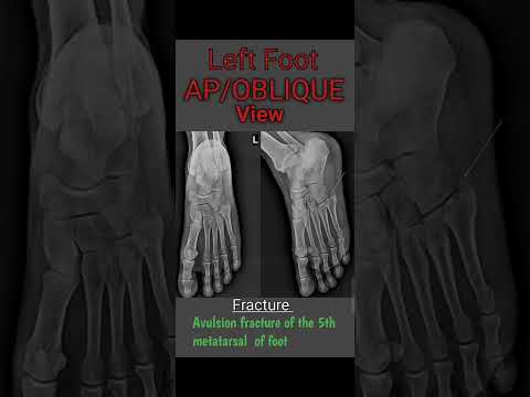 X-ray foot AP/Oblique View