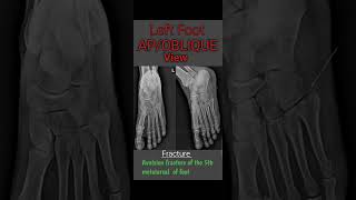 #X-ray foot AP/Oblique #View #X-ray foot AP/Oblique #View