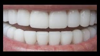 الوصفة المعجزة لتبييض الاسنان و ازالة الاصفرار  النتيجة سوف تبهرك أسنان بيضاء  النتيجة صادمة