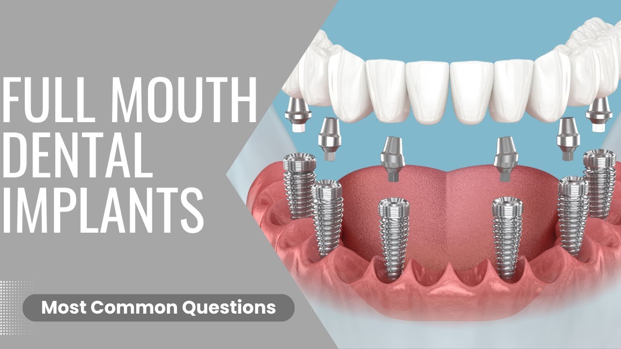 All Teeth on 4 Dental Implants: 10 Most Common Questions Answered by Dr Helen
