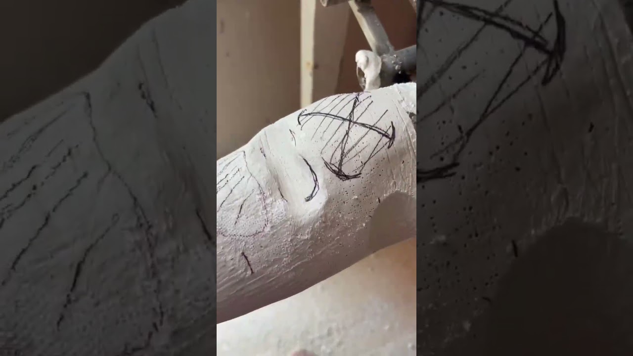 TransTibial Cast Modification | below knee cast modification| TTP | BKP