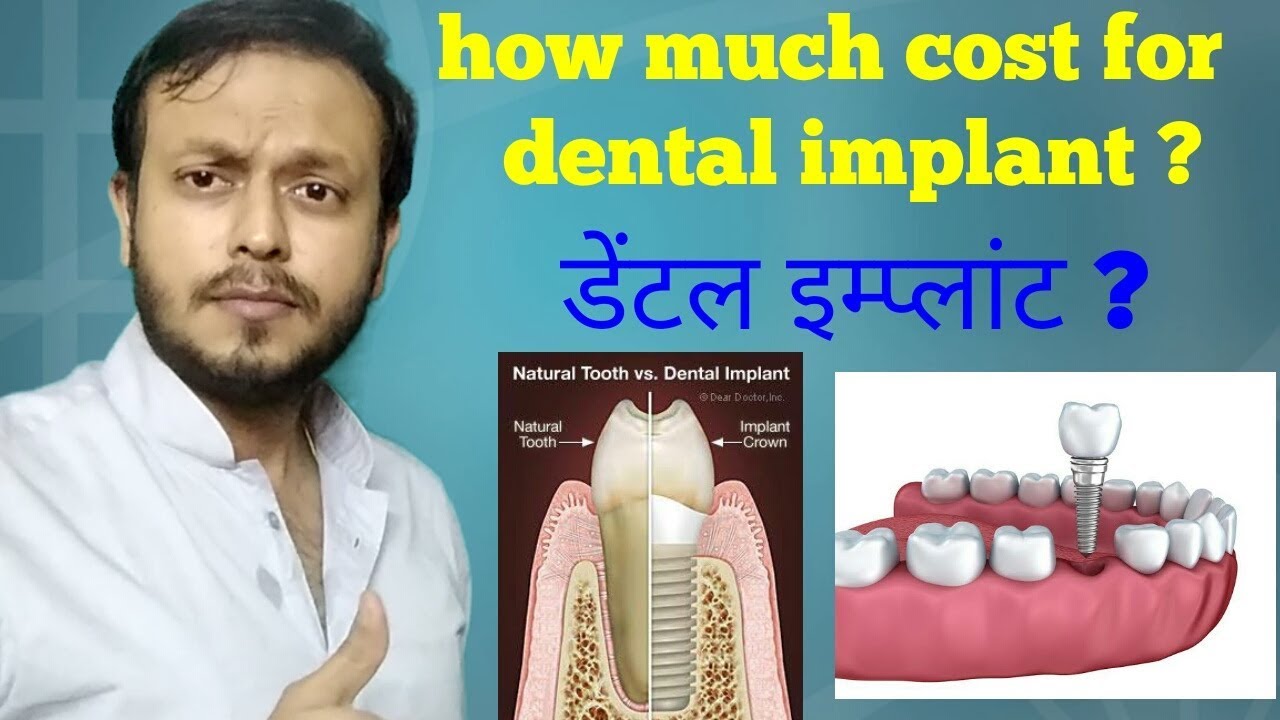 What is Dental Implant and Cost in Hindi , डेंटल इम्प्लांट क्या है ? 