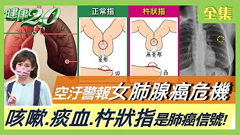 空污拉警报 女肺腺癌上升惊人！ 秦杨肺长3颗结节 罹癌险高？ 咳嗽、痰血、杵状指是肺癌信号！ 揪出早期肺癌 哪种检查最有效？ 健康2.0 20220402 (完整版) - 天天要闻