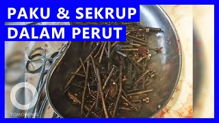 Download Lagu Lebih dari 1 Kg Paku dan Sekrup Dalam Perut Pria Ini - TomoNews MP3