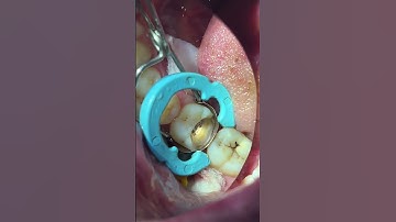 Sectional contoured matrix band with Resin ring