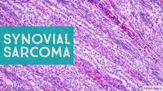 Synovial Sarcoma 101…Explained by a Soft Tissue Pathologist