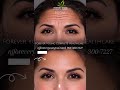 Forehead Wrinkle Treatment in NJ | Before & After Results | Forever Young MD