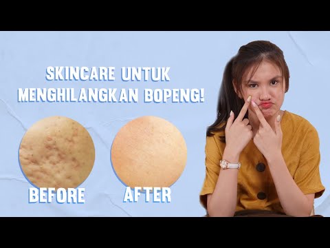 DIY Masker Alami Ampuh Untuk Jerawat, Komedo, Bekas Jerawat, Wajah Kusam. 