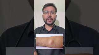 Can Lipoma be treated without surgery? Medicine for lipoma? Lipoma treatment by Dr Animesh #shorts screenshot 2