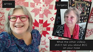 What the other videos don’t tell you about Basal Cell Carcinoma on your nose