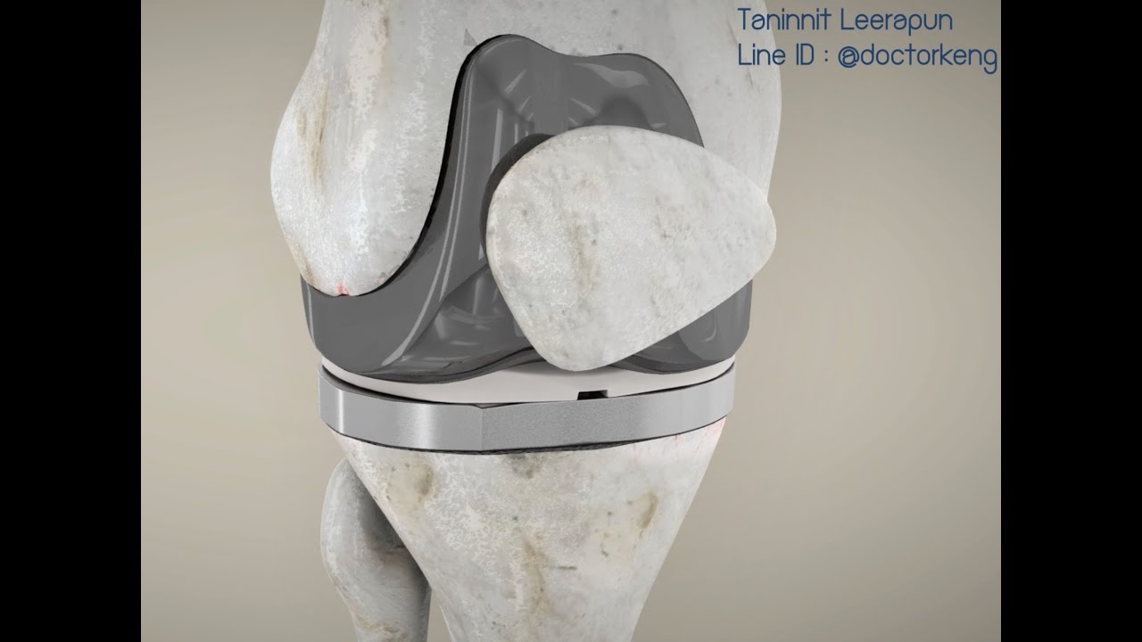 Total knee replacement การผ่าตัดเปลี่ยนข้อเข่า by Taninnit Leerapun, MD