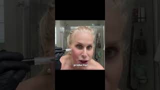 Christine's Demo Days:Benefits of Microneedling with PDO Glow Serum #microneedling#charlotte#newskin