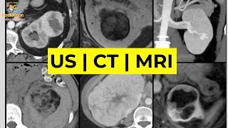 Imaging of Renal Masses [ALL YOU NEED TO KNOW] | Dr. Daniel J. Kowal (RadiologistHQ)