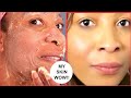 HOW TO MAKE AN ORDINARY CHEMICAL PEEL AT HOME USING SIMPLE INGREDIENTS, ERASE DARK SPOTS & WRINKLES