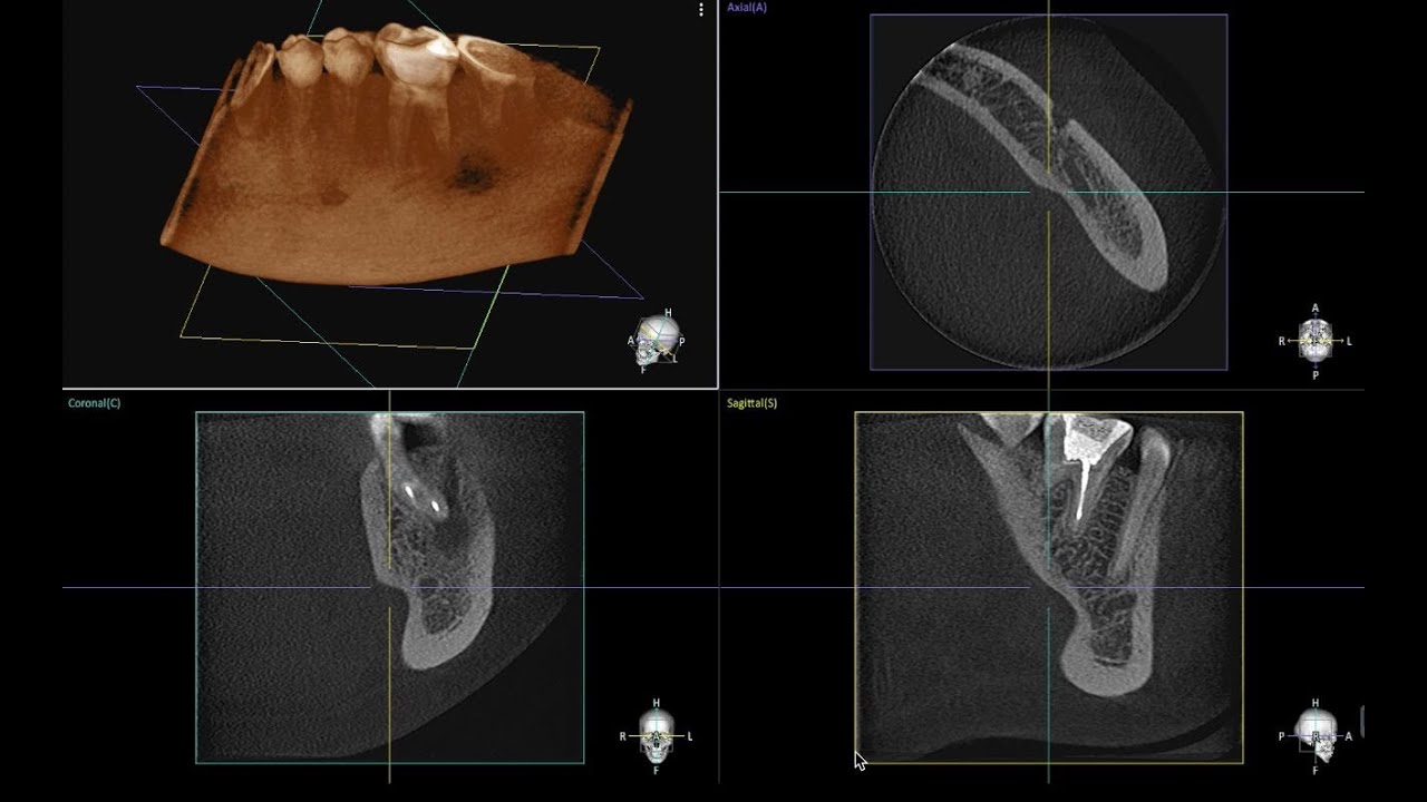 Tomografi görüntüleri ile Kasti Reimplantasyon