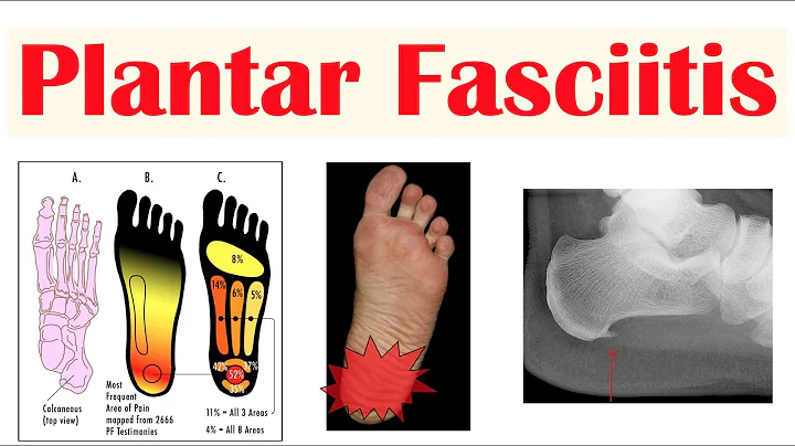 Fascite Plantar: Dor Intensa no Calcanhar - Causas, Sintomas e Tratamentos