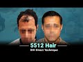 Hair transplant in india  dhi india results  cost of hair transplant in india