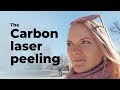 Вся правда о карбоновом пилинге от врача косметолога — The Carbon Laser Peel — Larionova.md