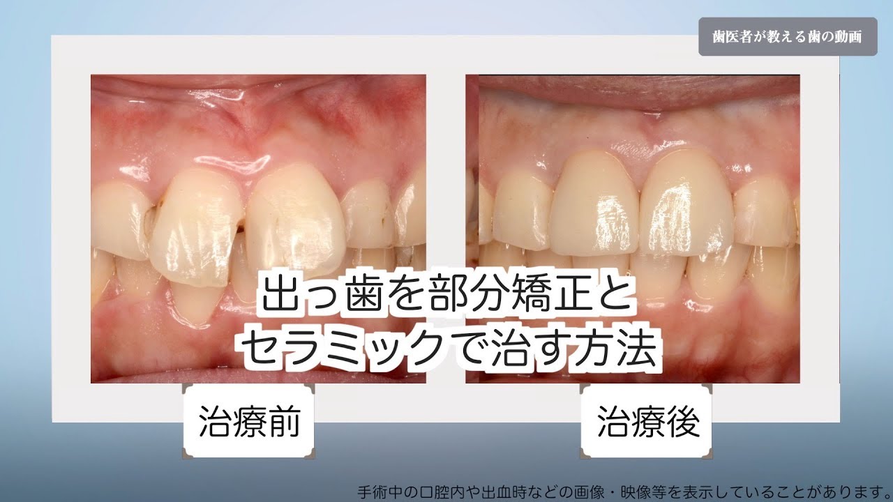 出っ歯を部分矯正とセラミックで短期間で治す方法 Youtube