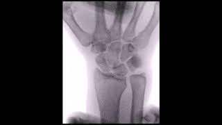 midcarpal instability and midcarpal shift test Nr.2