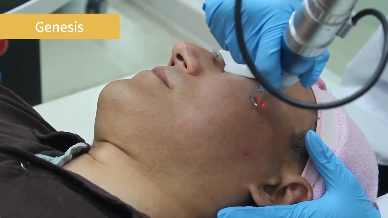 Finebeam Laser 1064 nm & 532 nm Q-Switched ND:YAG LASER