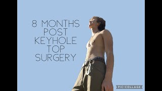 8 Months Post Keyhole FTNB Top Surgery: How I chose keyhole for my surgery.